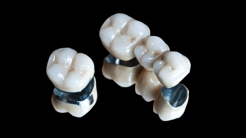 Cruz Dental Studio_Service_PFM