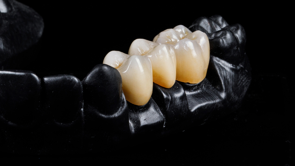 Cruz Dental Studio_Service_crown-and-bridge